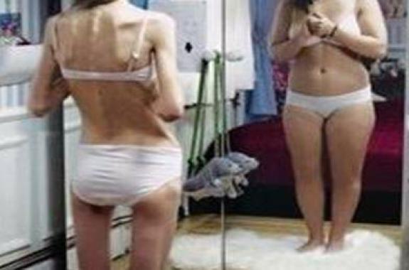 Η ψυχογενής ανορεξία στους εφήβους - Γράφει η Ειρήνη Χατζηαναγνώστου